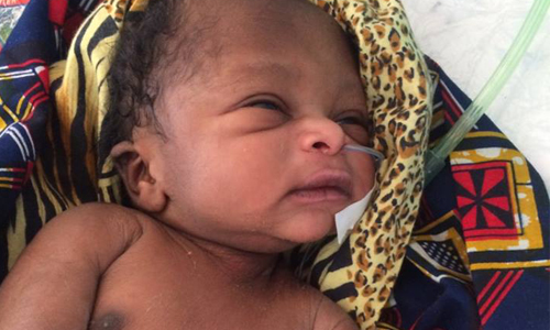 Newborn in Tanzania who suffered severe birth asphyxia